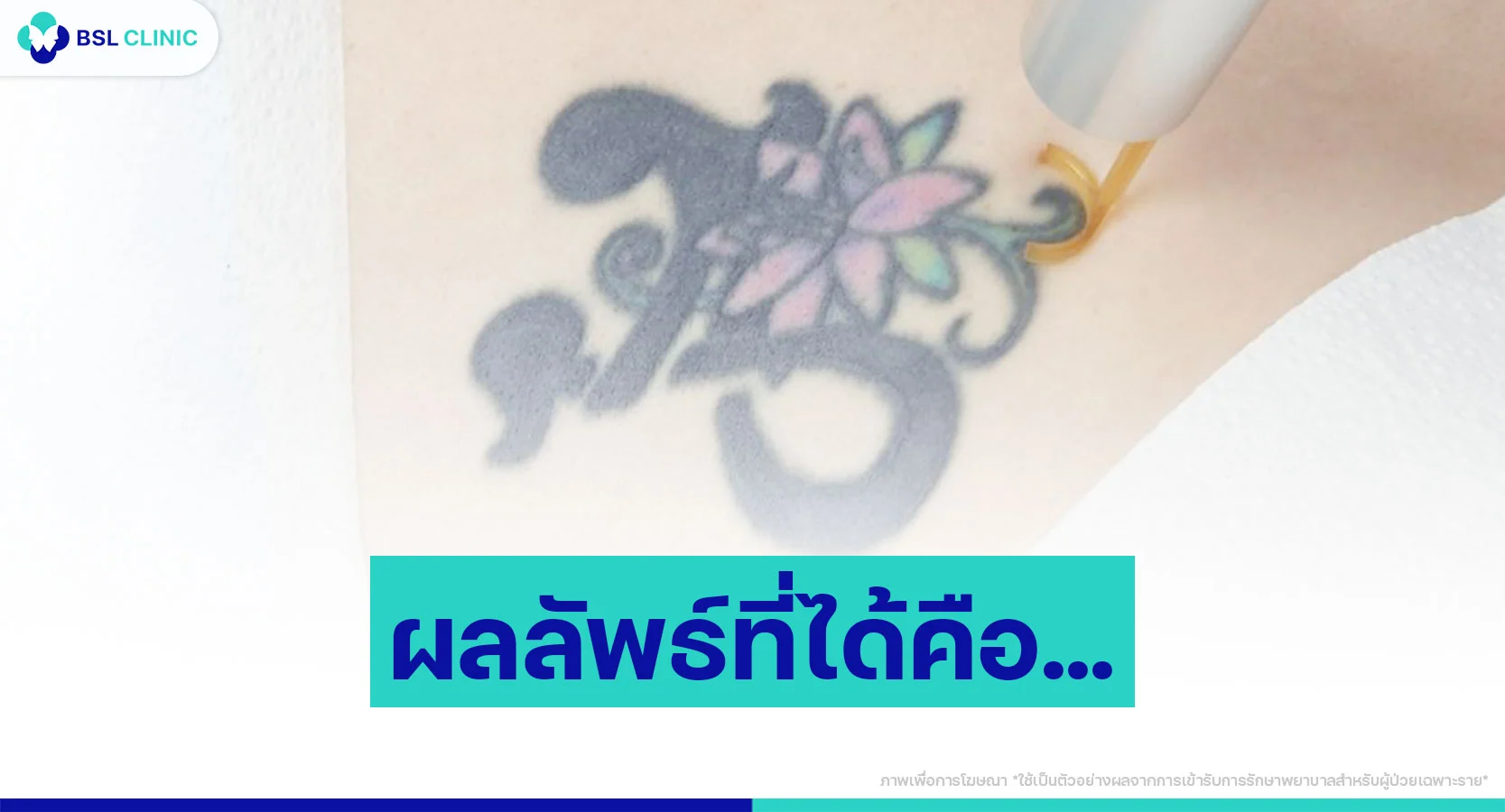 ลบรอยสักที่ไหนดี