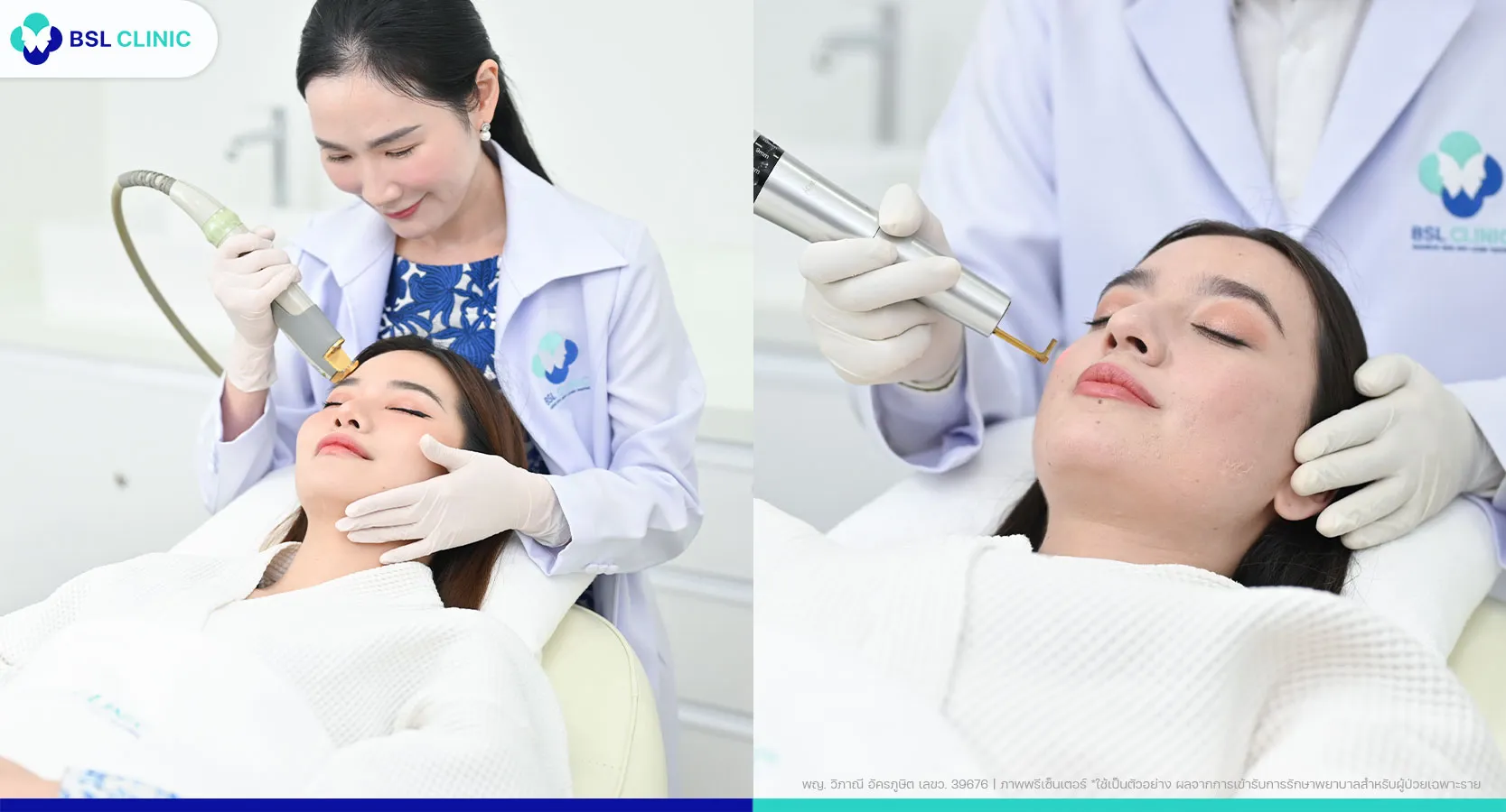 รักษาสิวอุดตัน