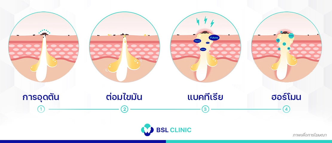 รักษาสิวตามสาเหตุ เฉพาะบุคคล