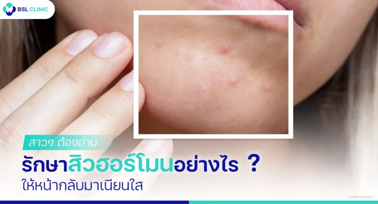 สิวฮอร์โมน สิวขึ้นคาง