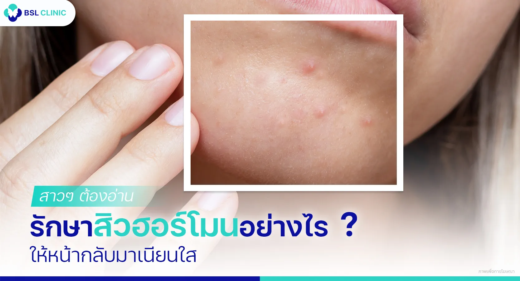 สิวฮอร์โมน