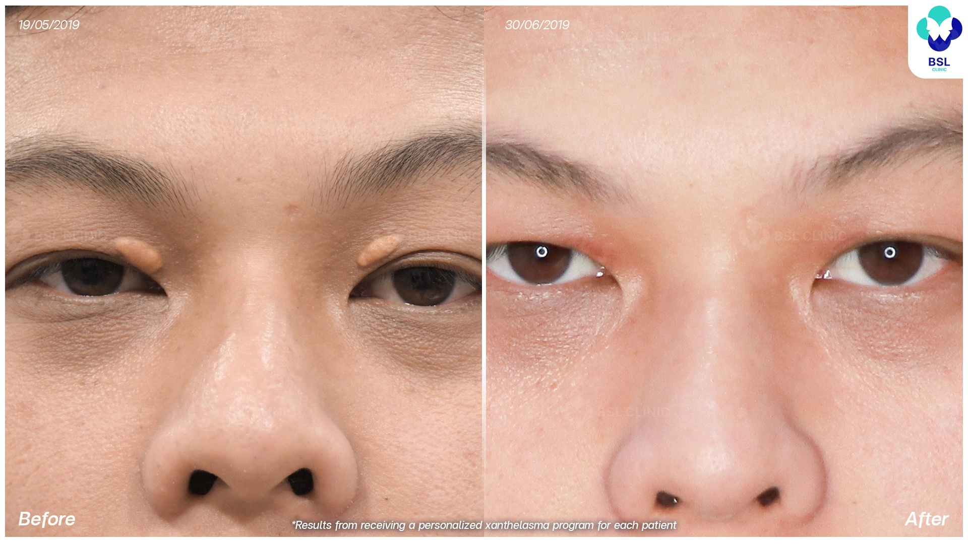 รีวิว ไฝ ขี้แมลงวัน กระเนื้อ