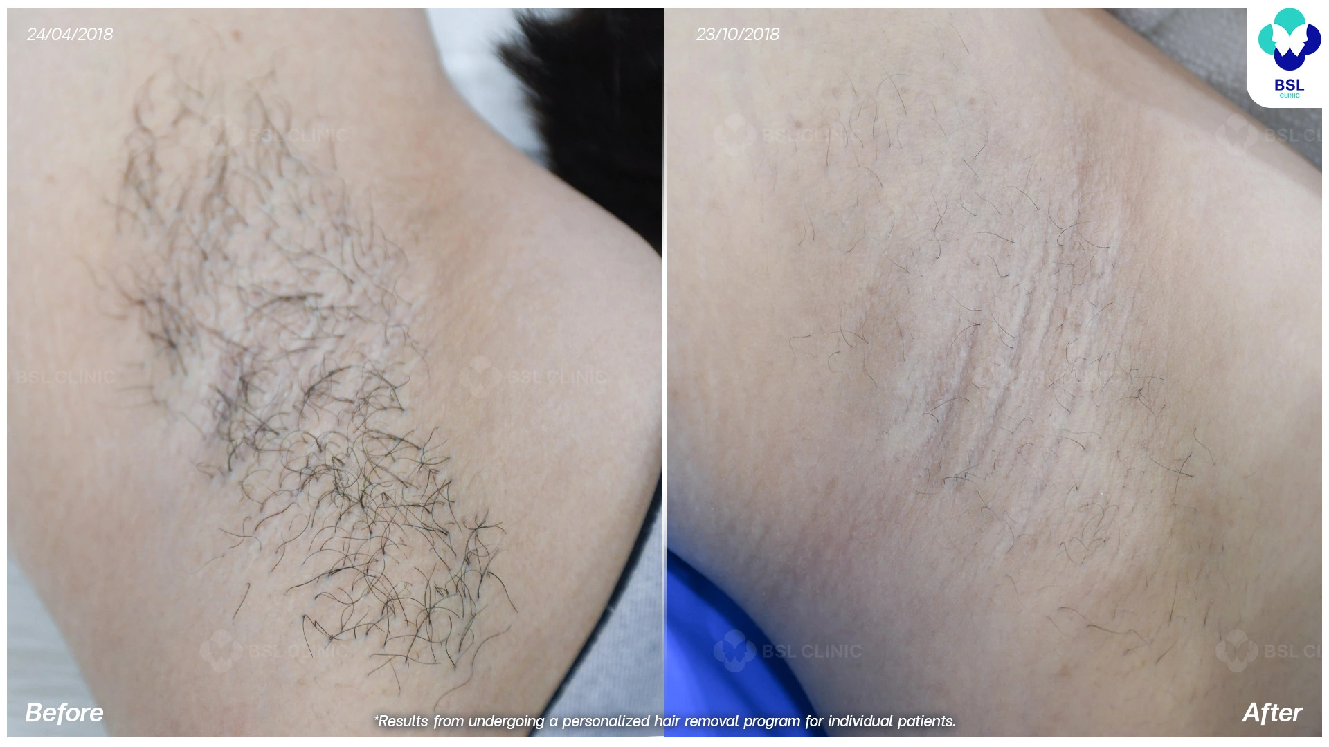 กำจัดขนรักแร้