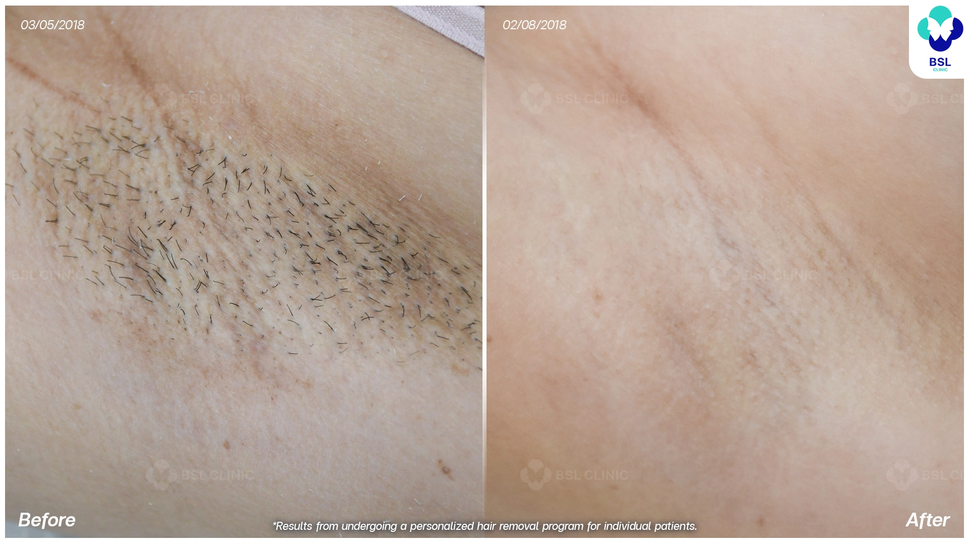 เลเซอร์กำจัดขน