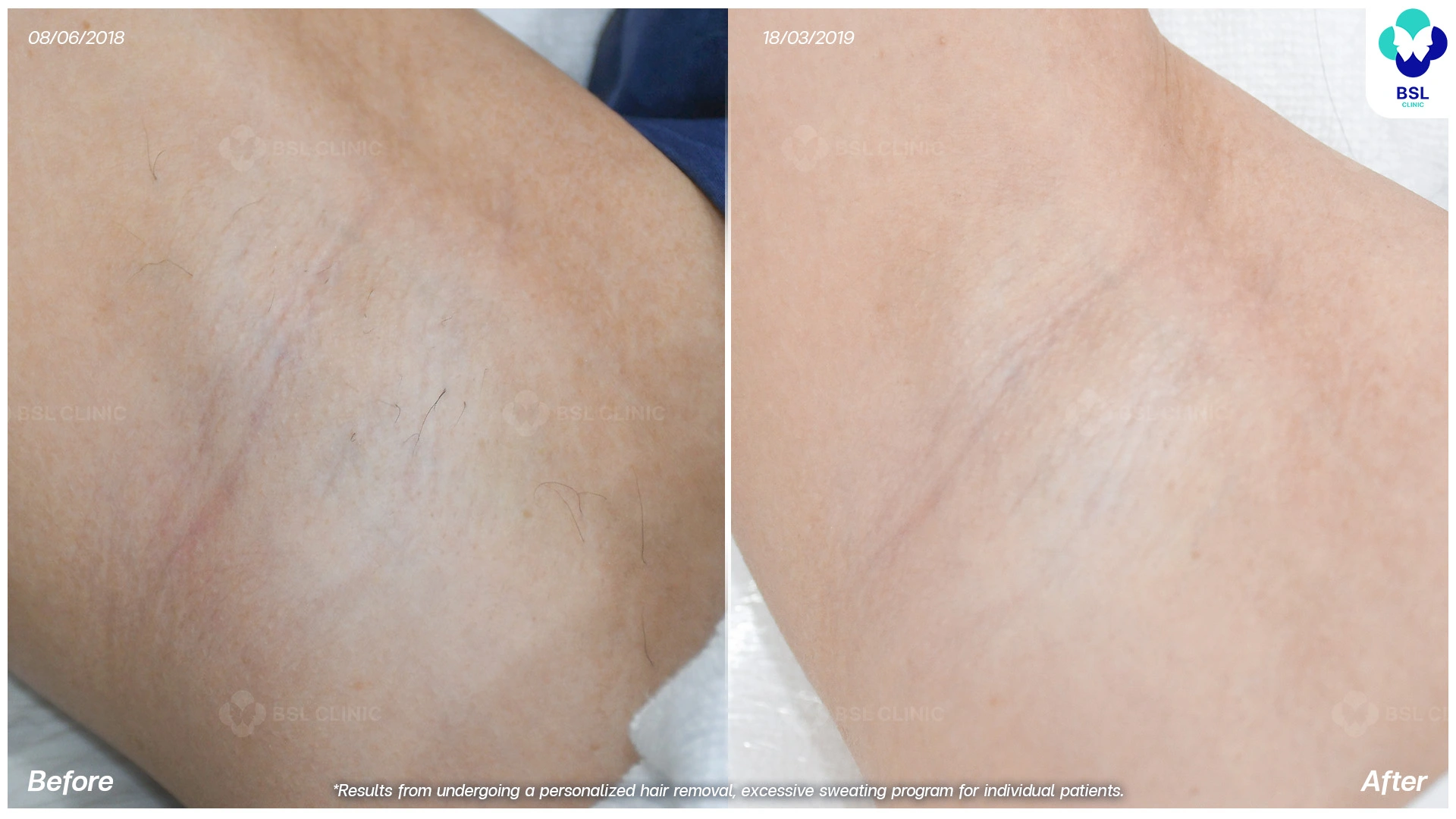 รักแร้เนียน ลดเหงื่อ