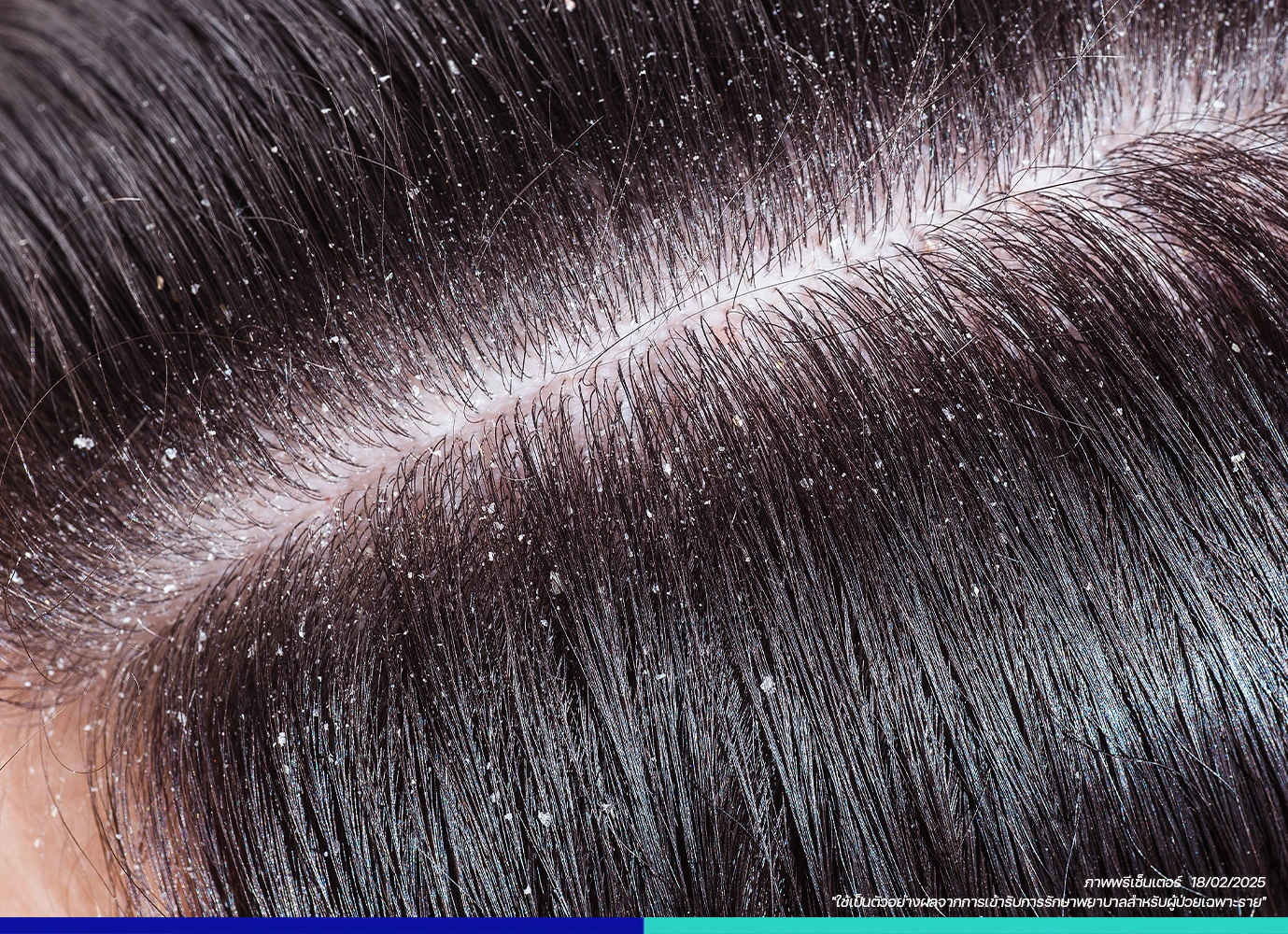 สาเหตุของการเกิดรังแค