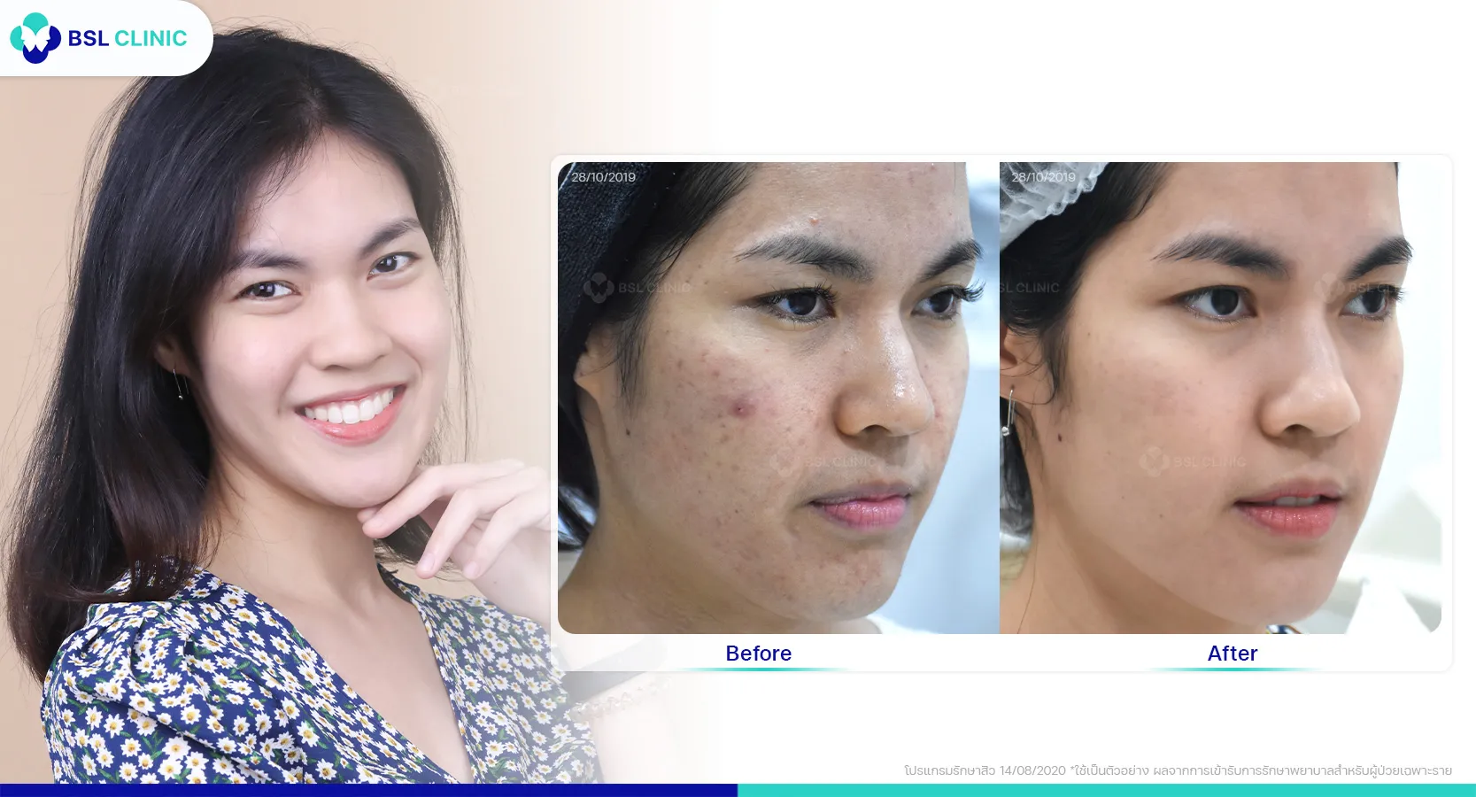 รีวิวจากผู้ใช้บริการจริง รักษาสิวจากการใส่แมส