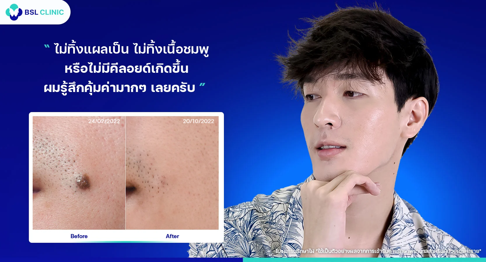 รีวิวเอาไฝออก