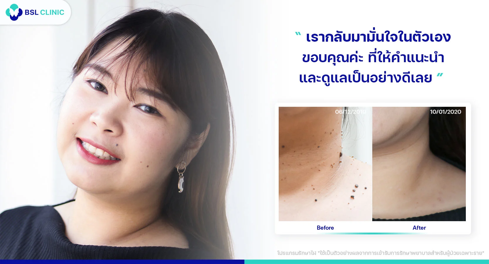 รีวิวเลเซอร์ไฝที่ไหนดี