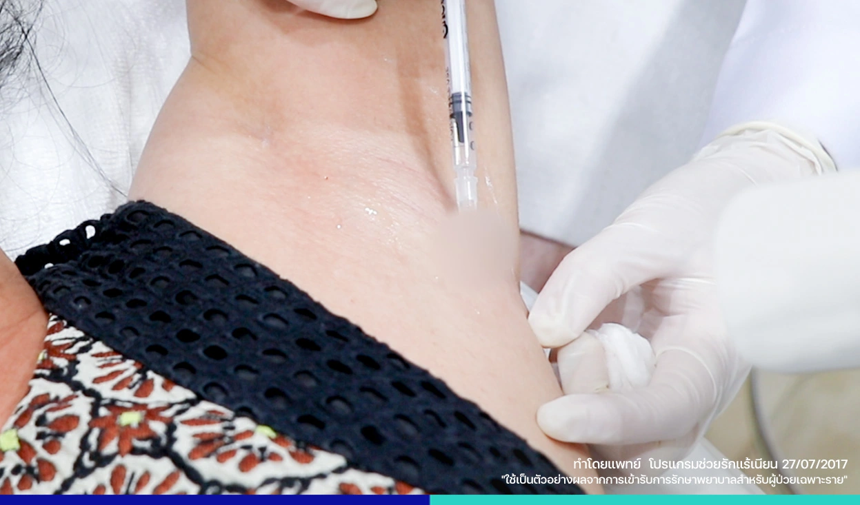 เลเซอร์ลดเหงื่อรักแร้