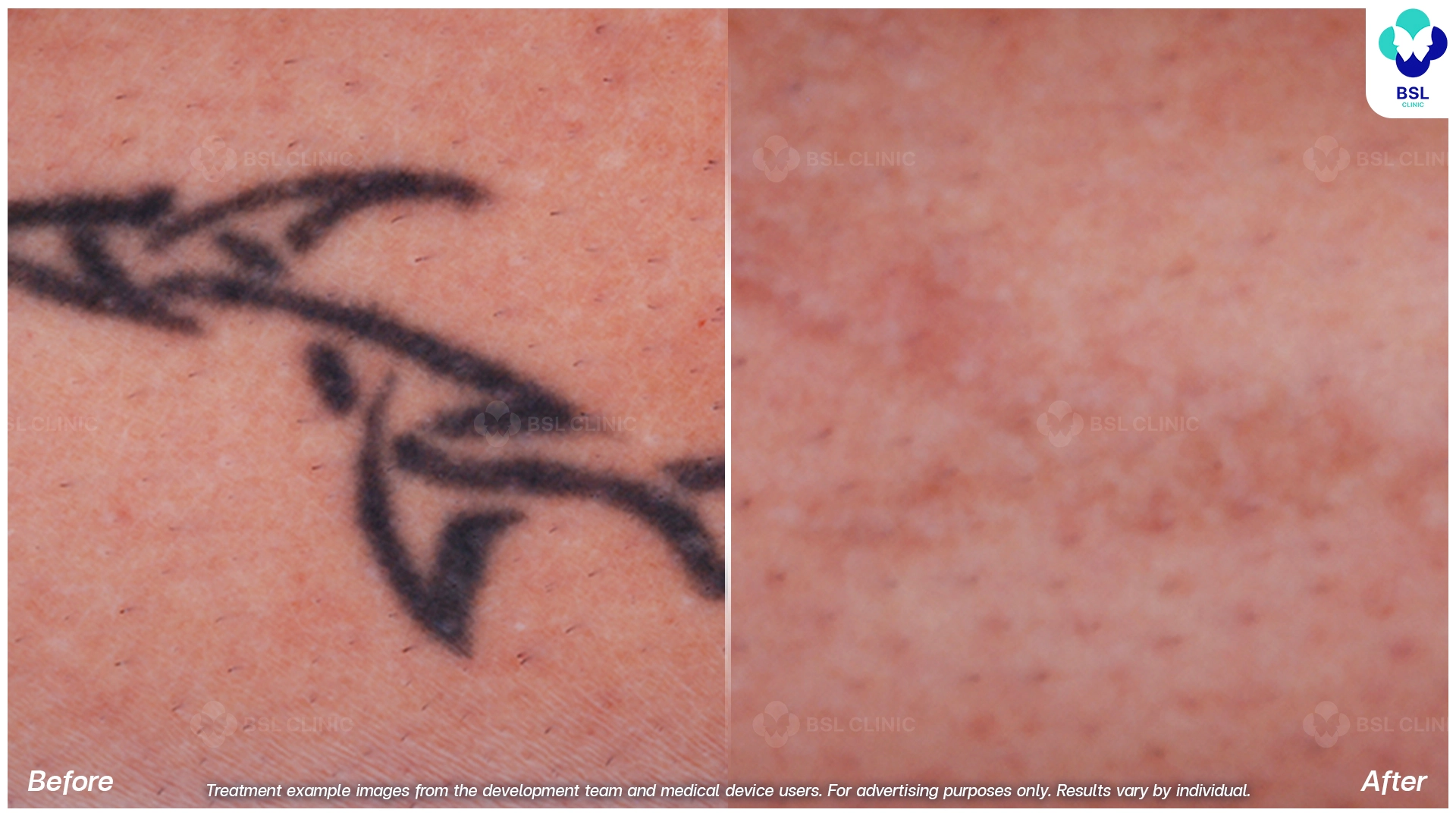 ลบรอยสักที่ไหนดี