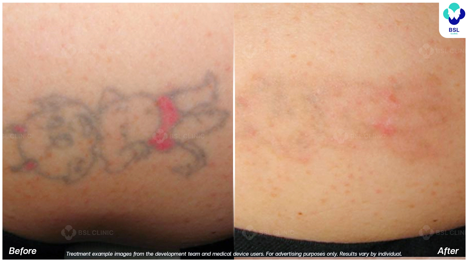 ลบรอยสักที่ไหนดี