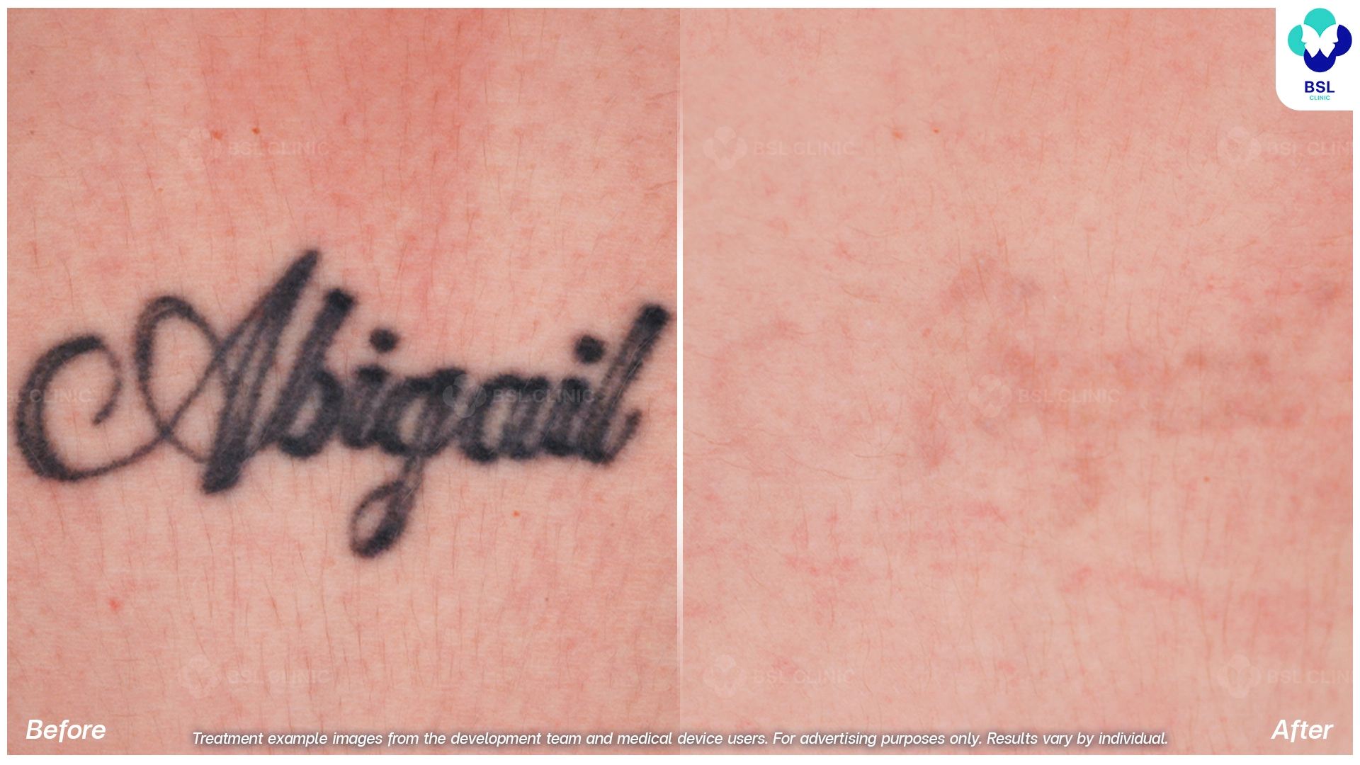 ลบรอยสักที่ไหนดี