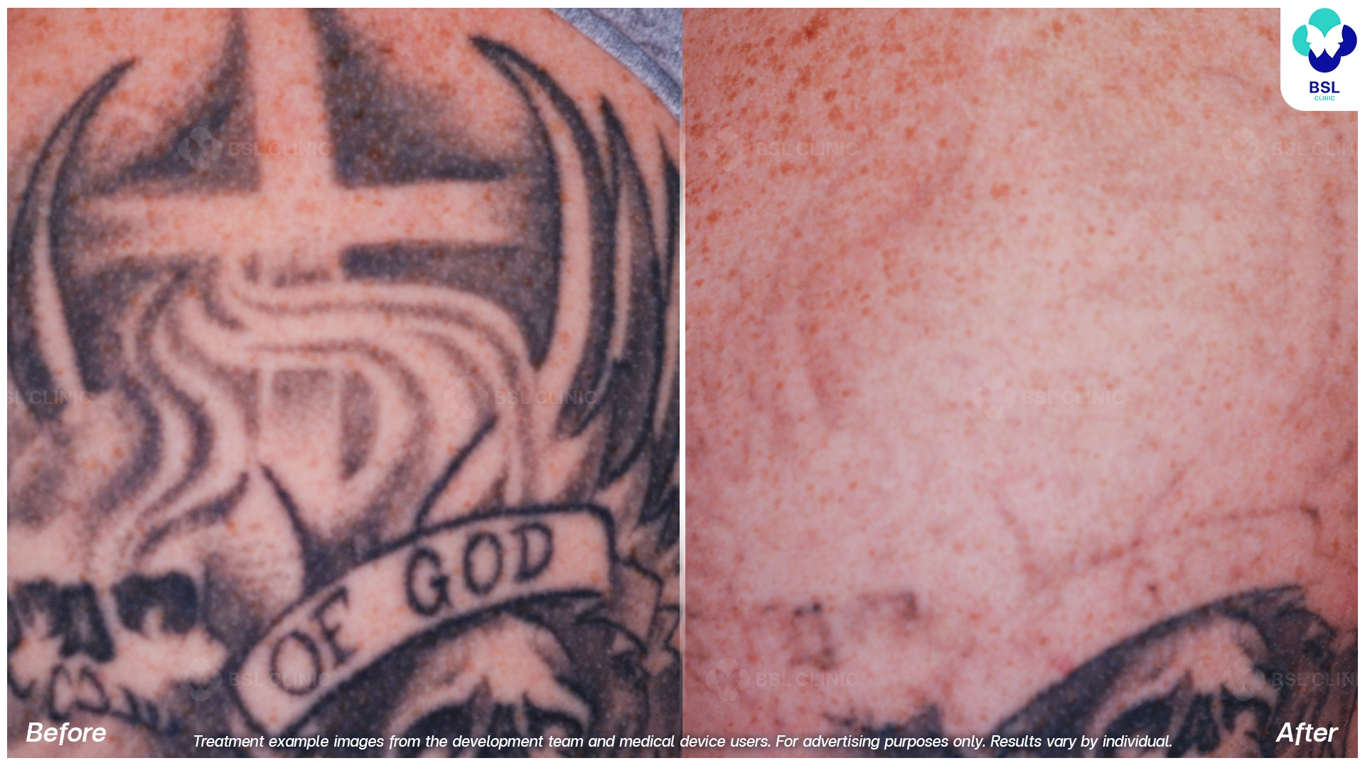 ลบรอยสักที่ไหนดี