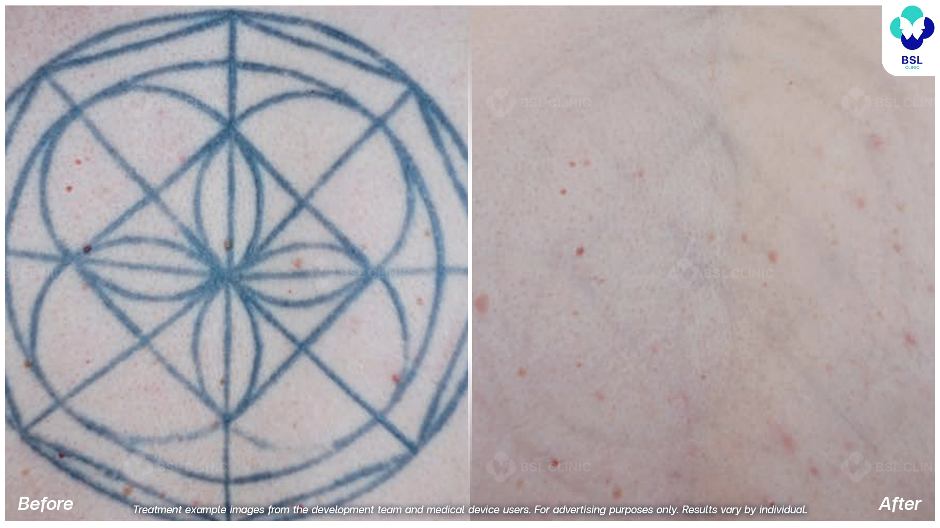 ลบรอยสักที่ไหนดี