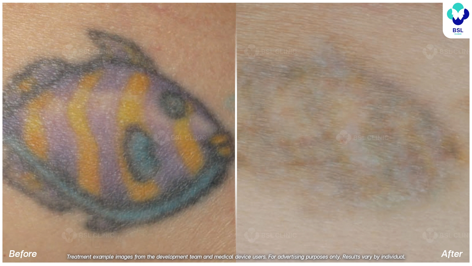 ลบรอยสักที่ไหนดี