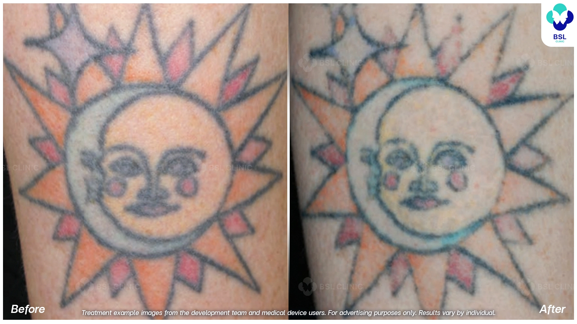 ลบรอยสักที่ไหนดี