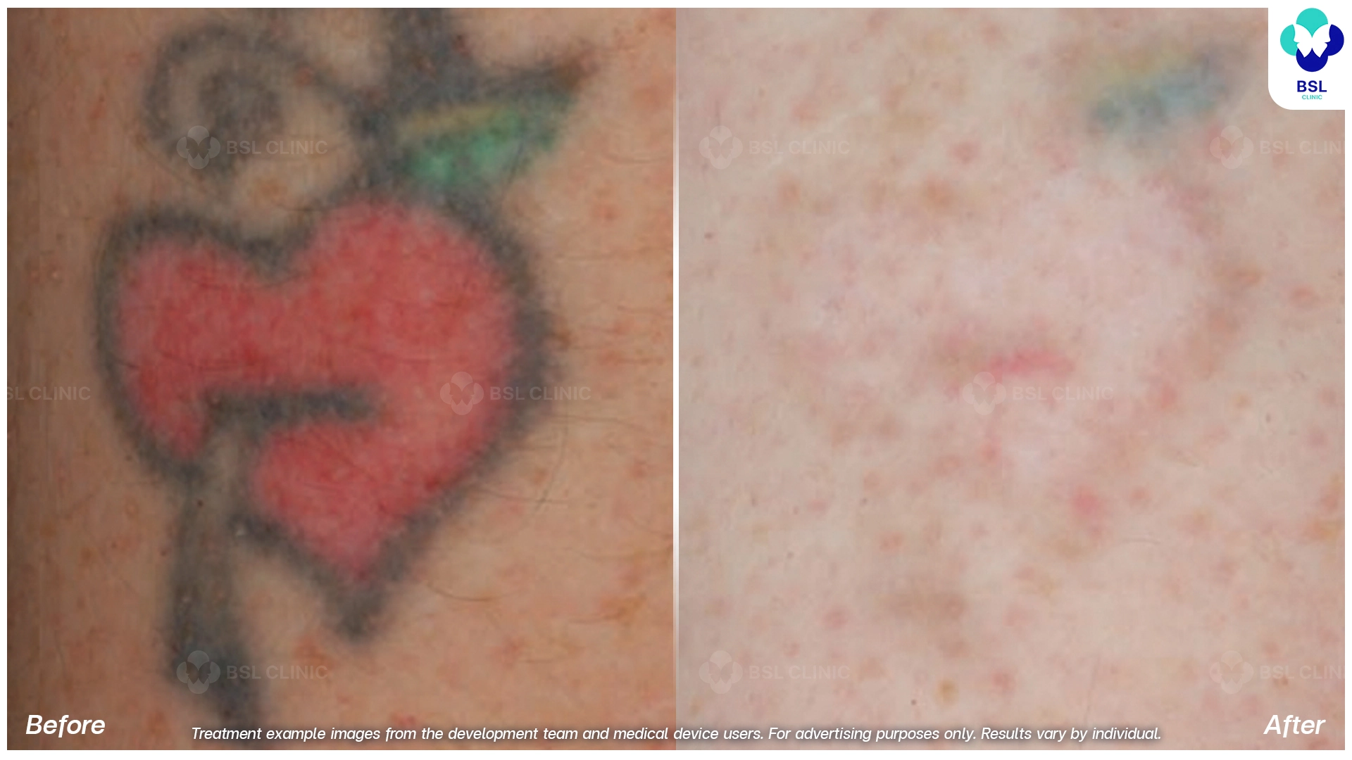 ลบรอยสักที่ไหนดี