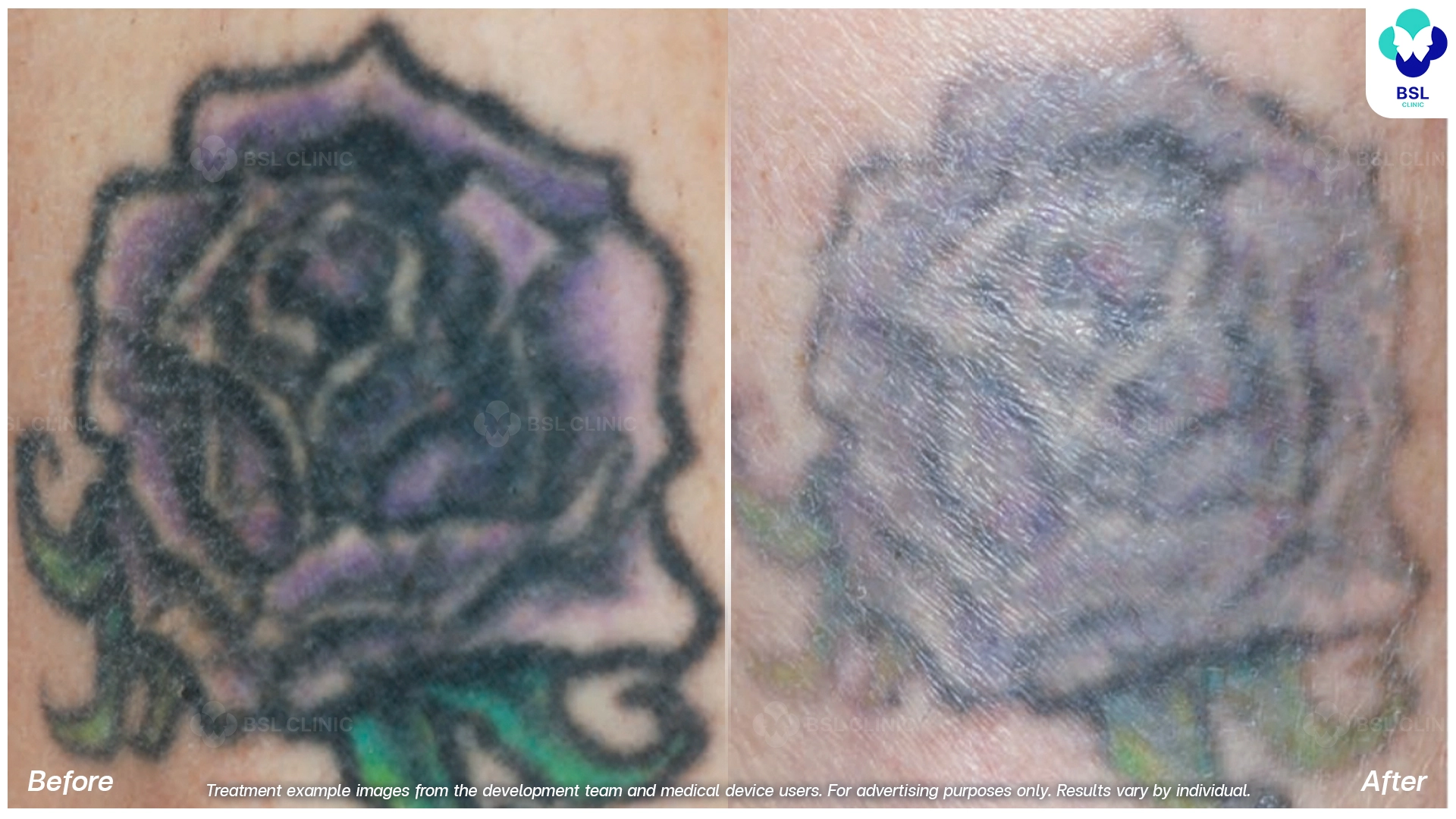 ลบรอยสักที่ไหนดี