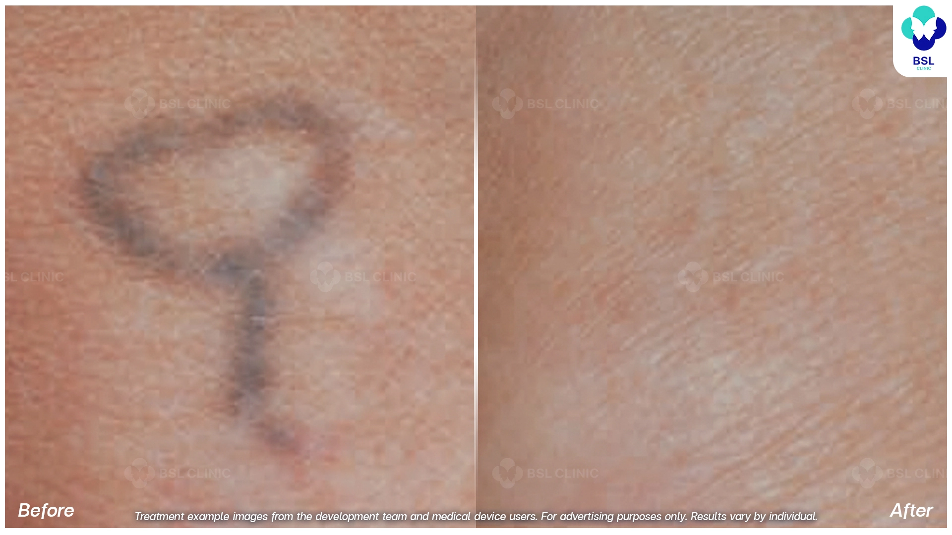 ลบรอยสักที่ไหนดี