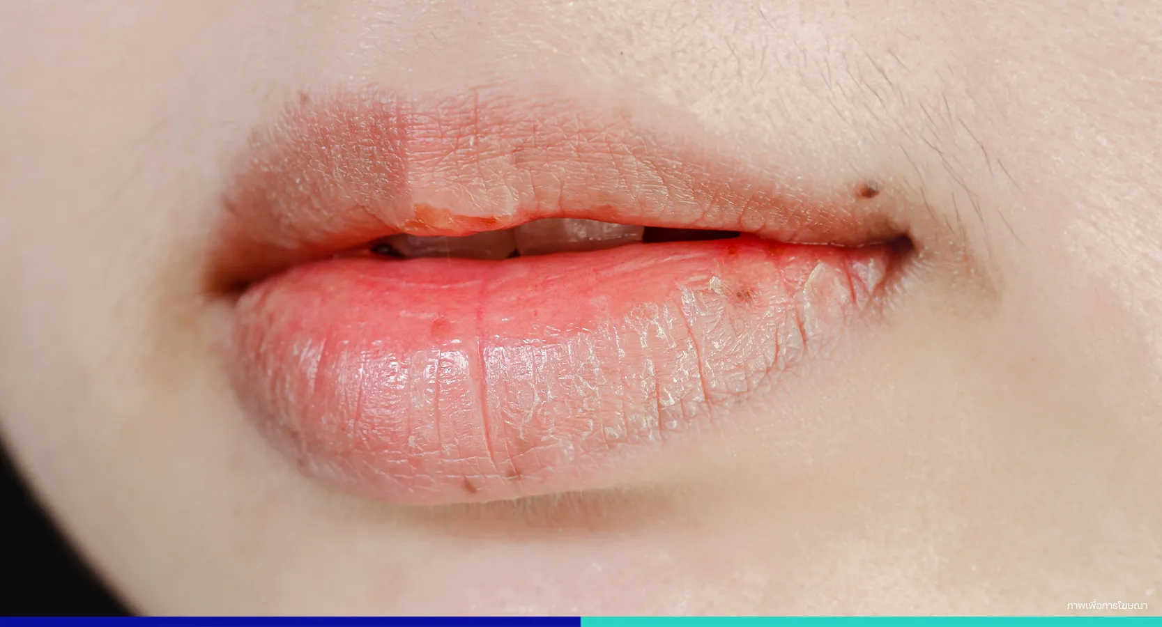 ริมฝีปากอักเสบ