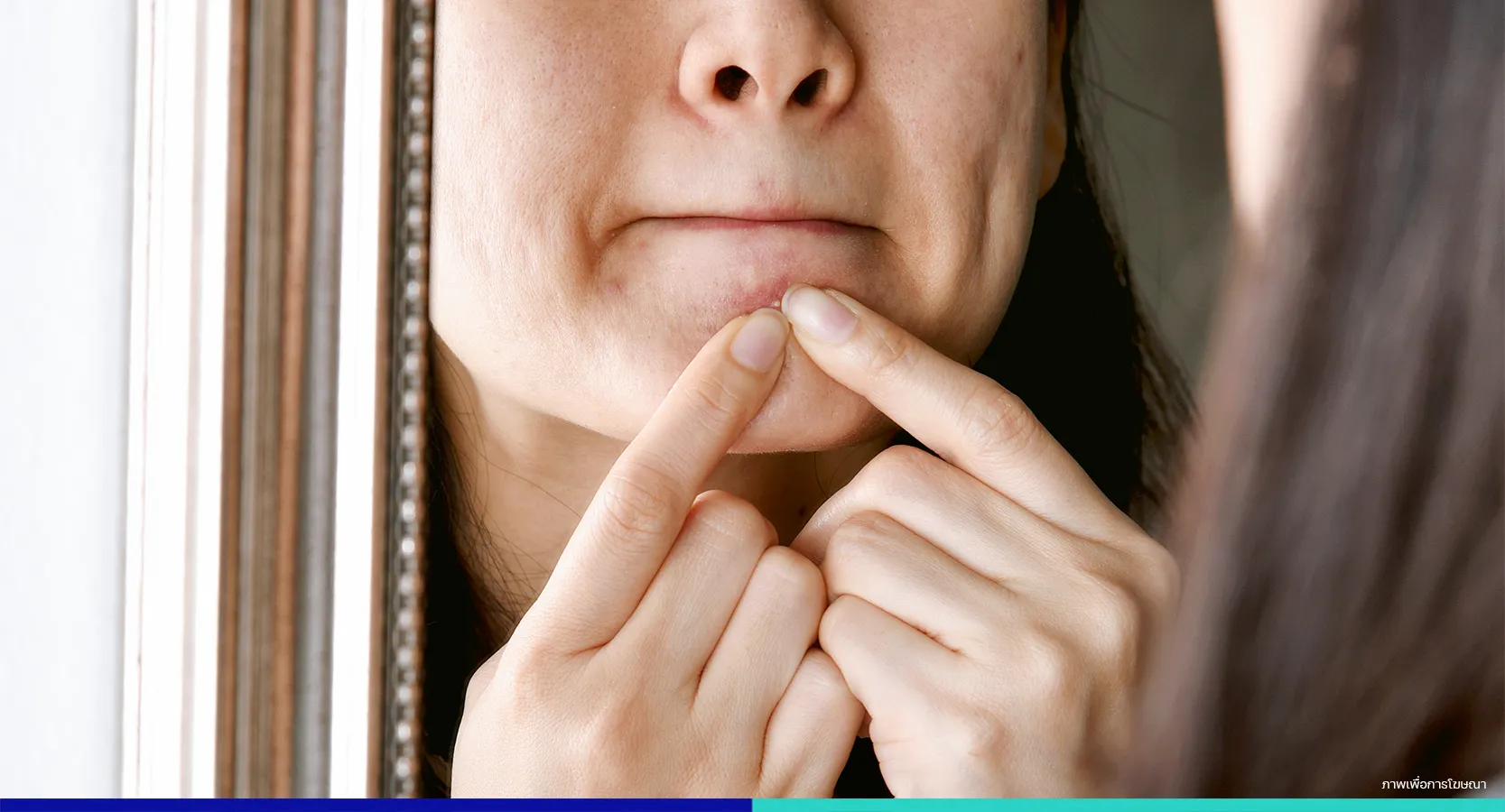 สิวขึ้นคาง