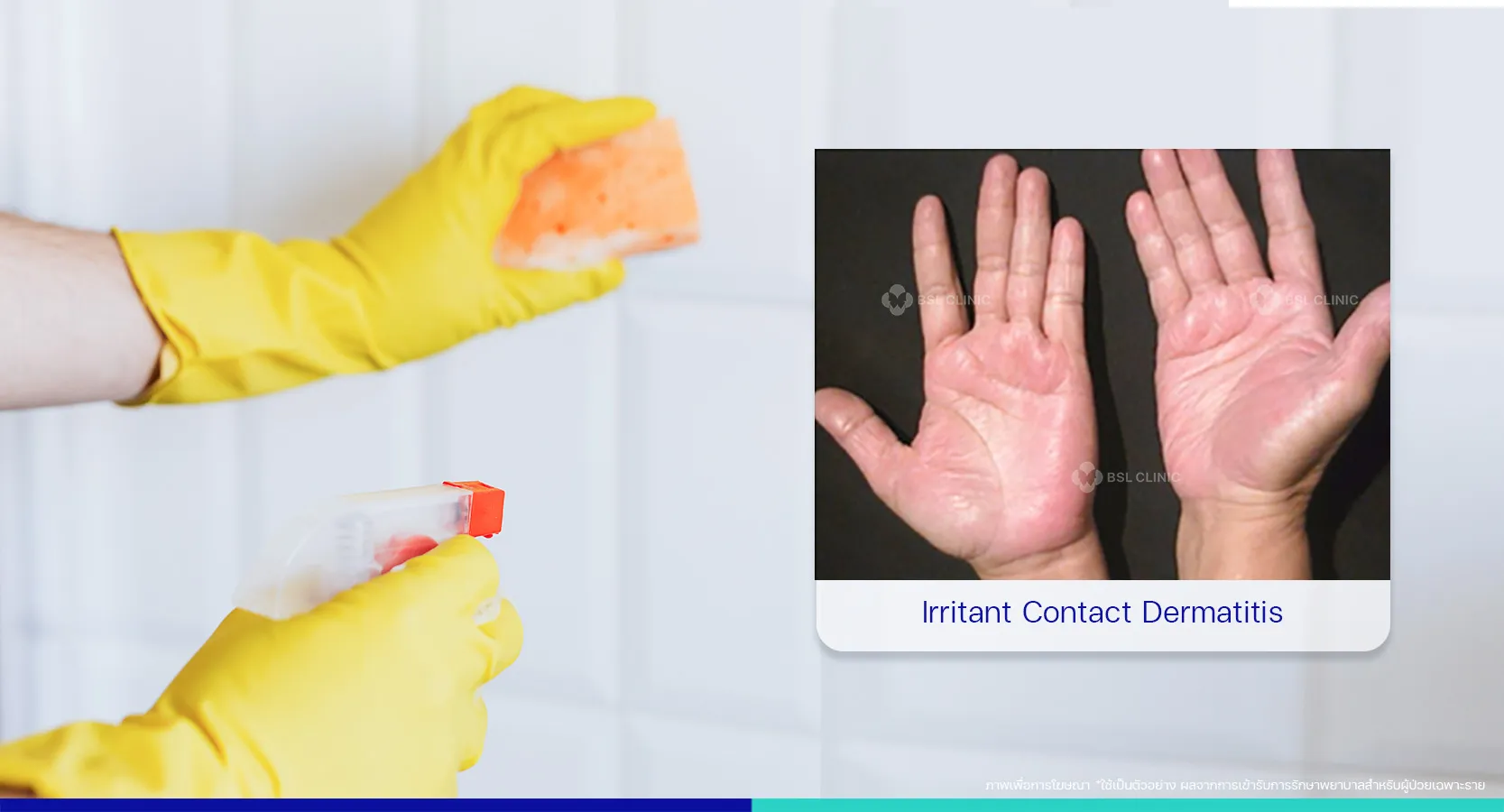 อาการแพ้ผิวหนัง