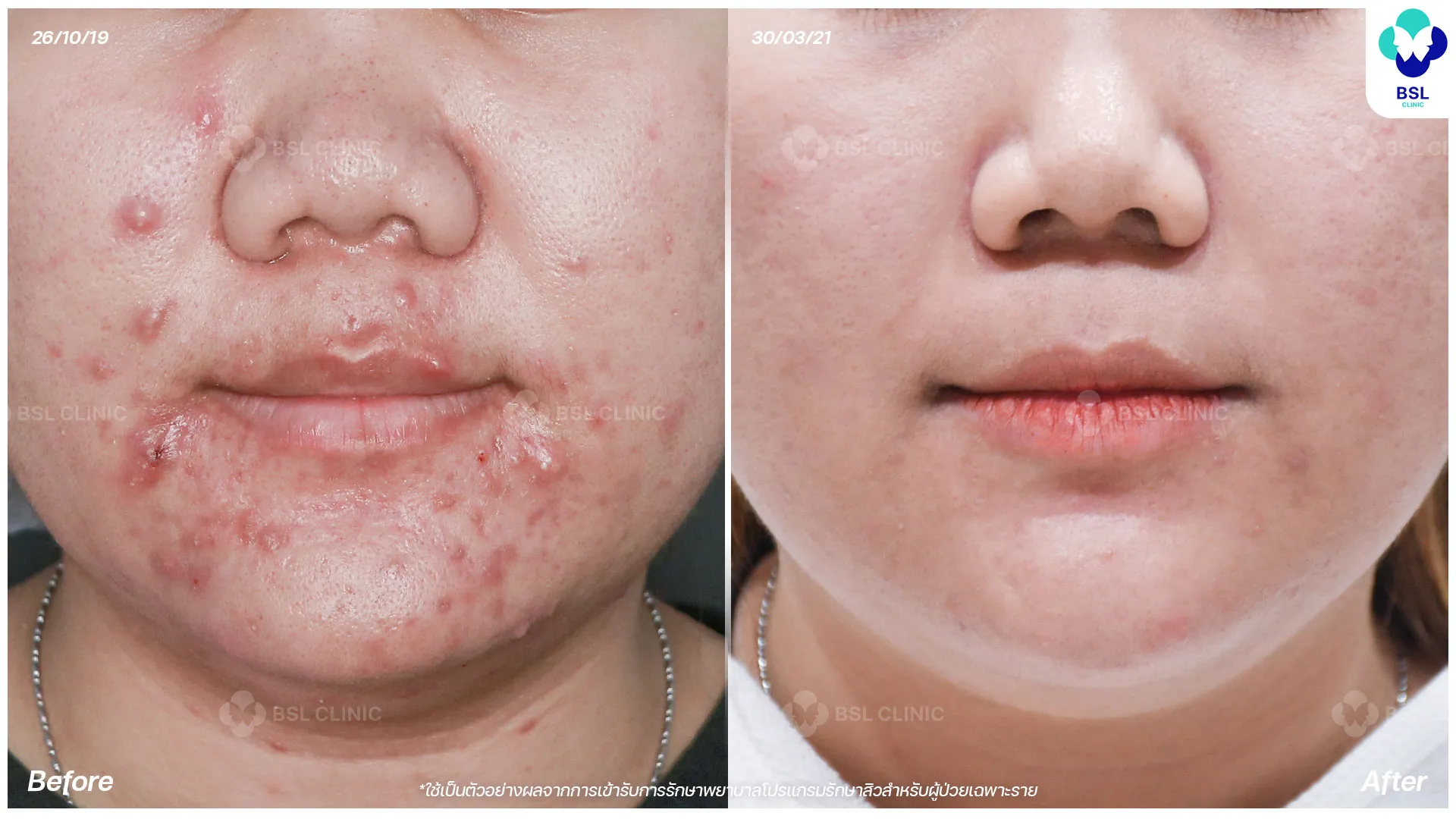 สิวฮอร์โมน