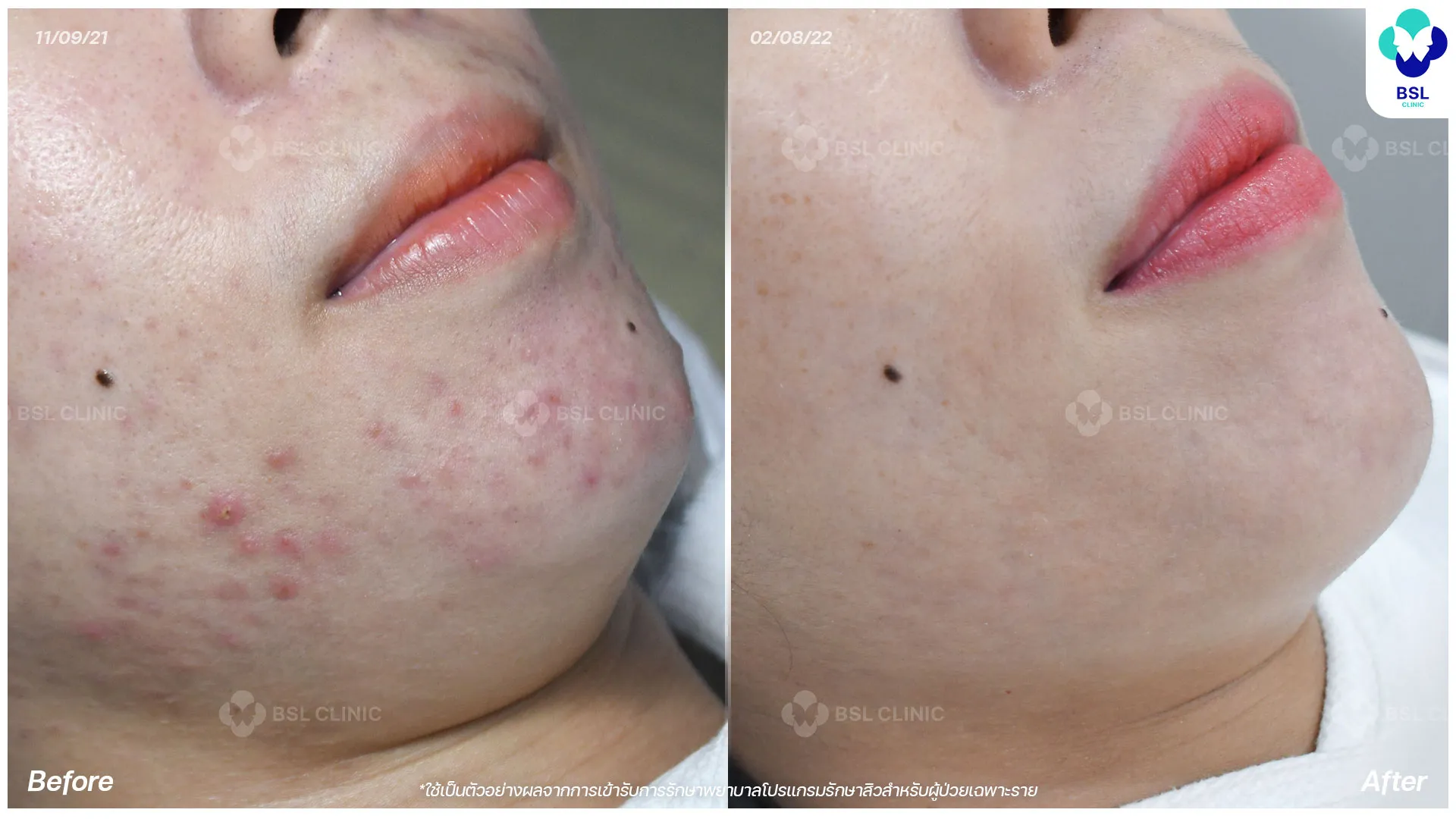 สิวฮอร์โมน