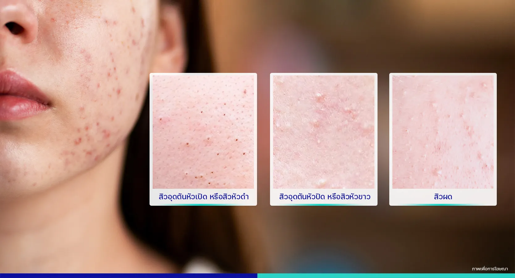 สิวอุดตันจากแมส