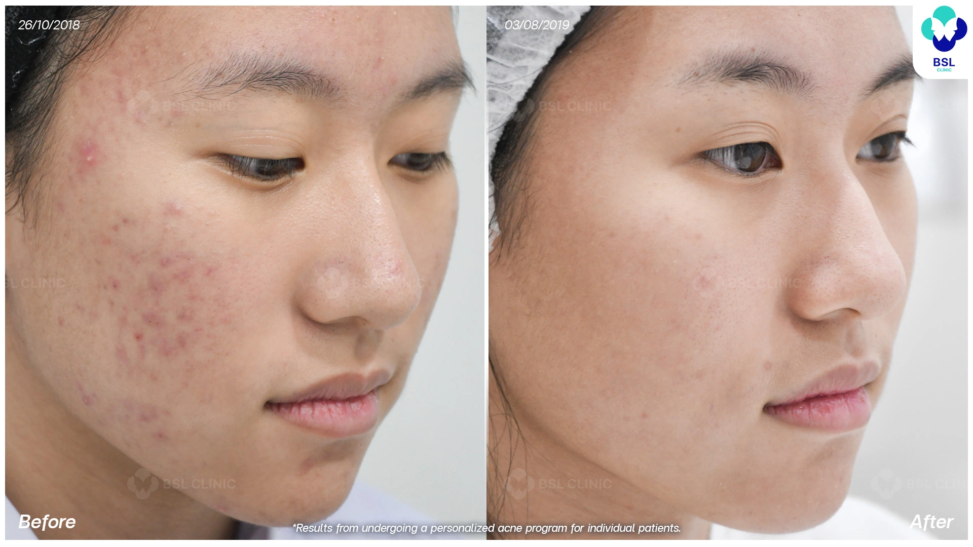 สิวอักเสบ