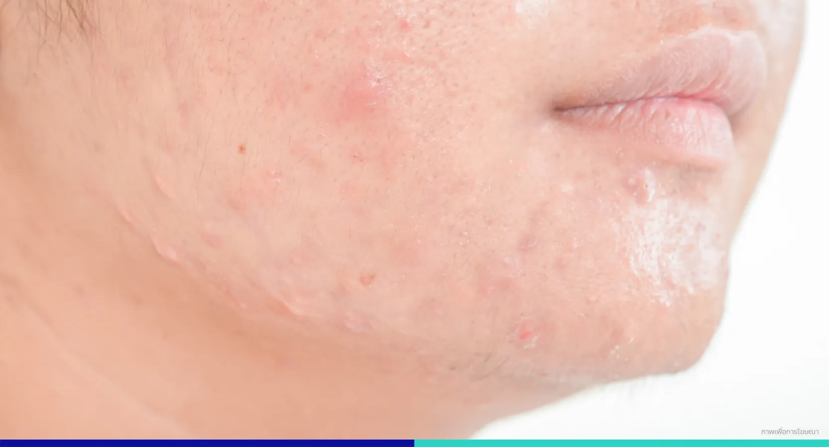 สิวฮอร์โมน