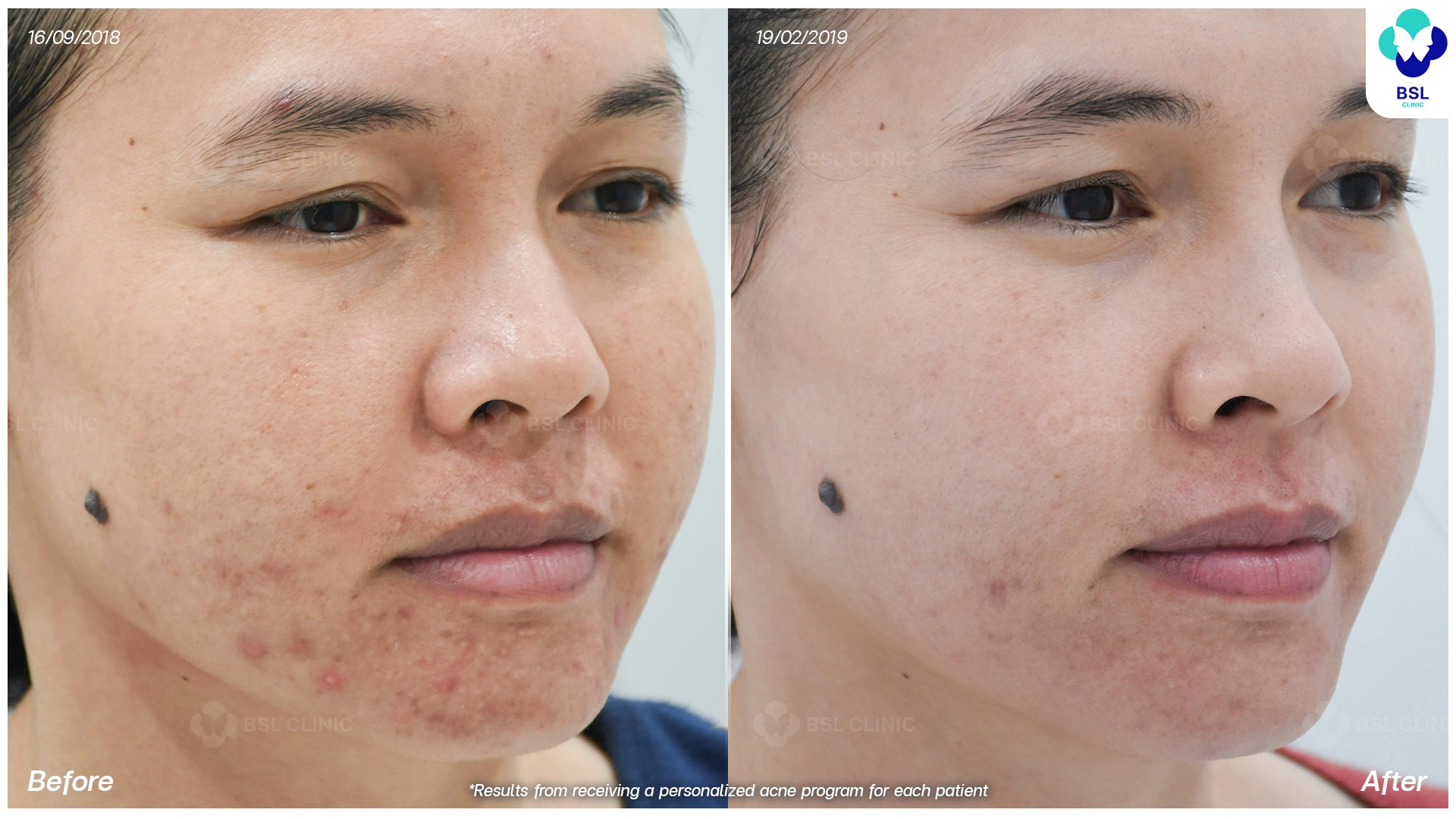 วิธีเลือกหมอสิว