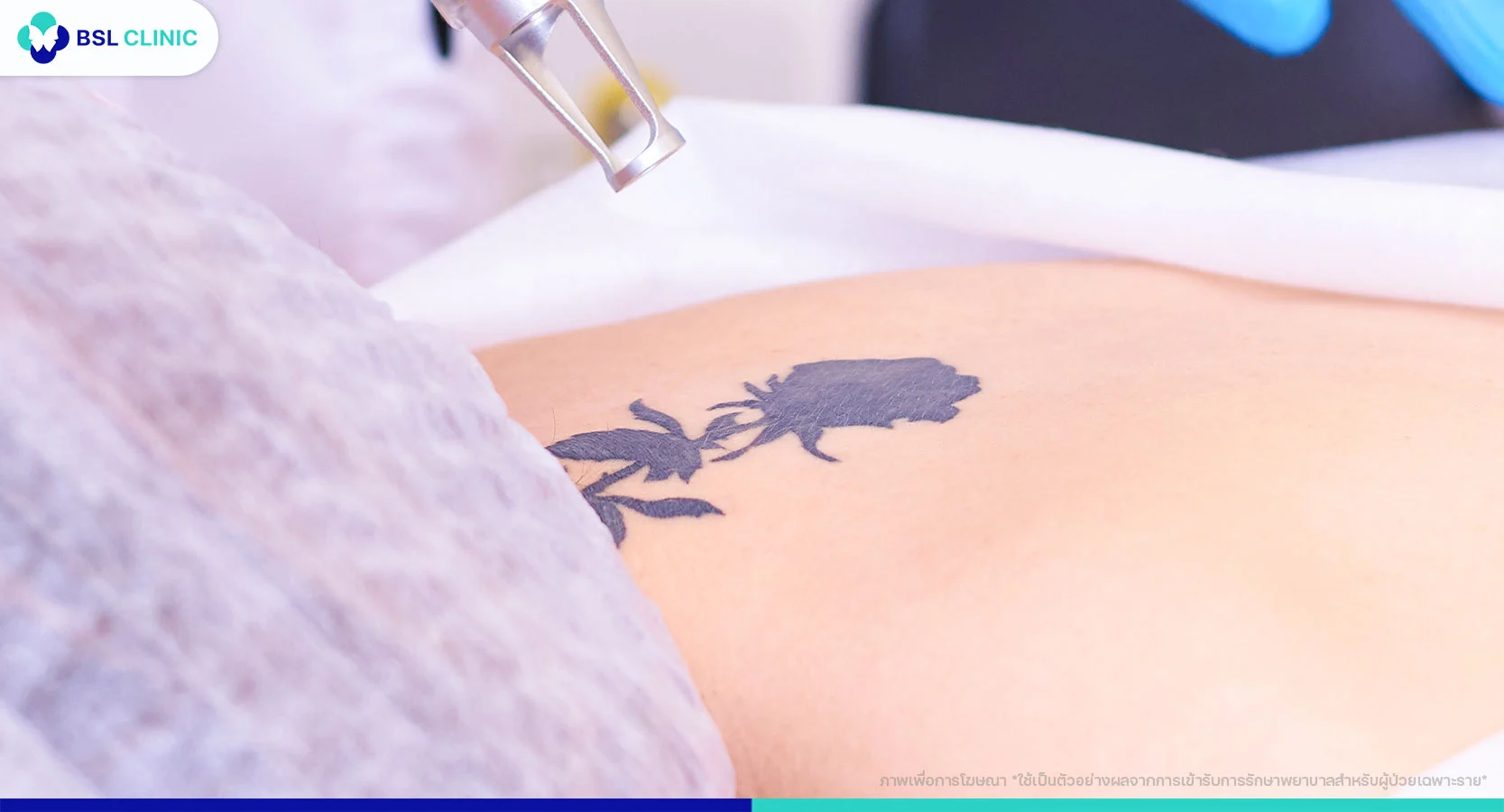 ลบรอยสักที่ไหนดี