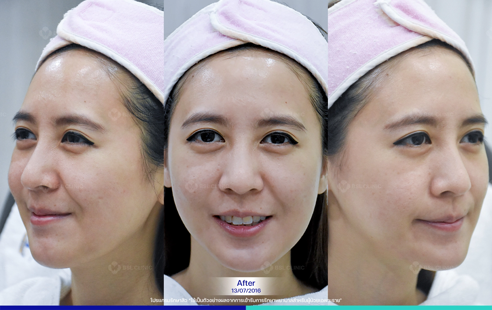 รีวิว BSL รักษาสิวดีไหม