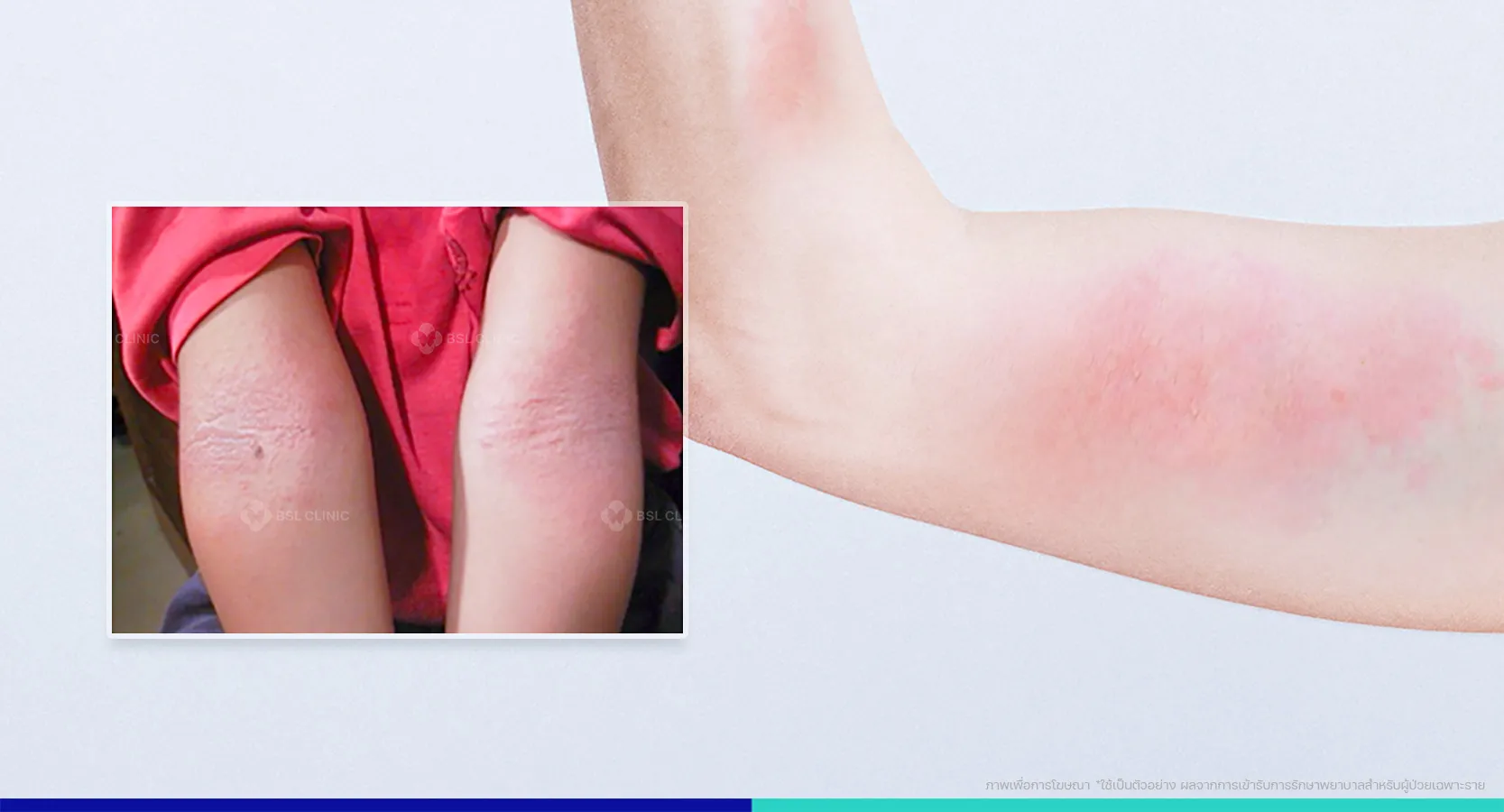 ผื่นคัน