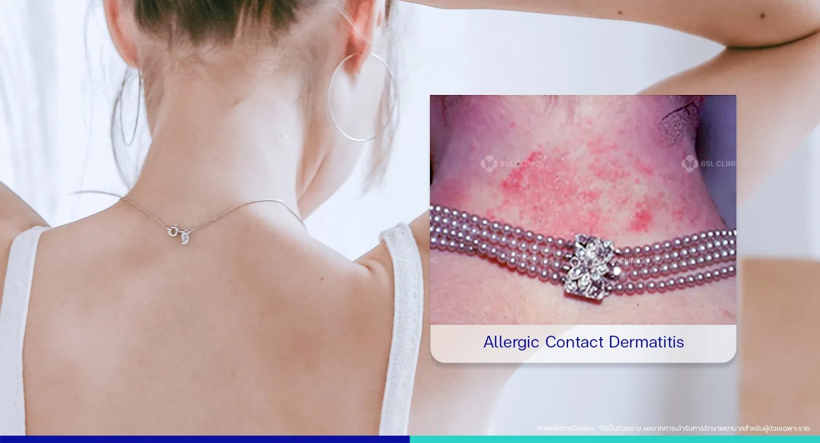 ผื่นคัน