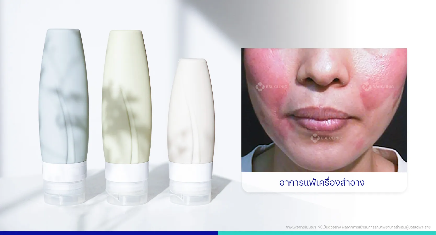 ผื่นคัน