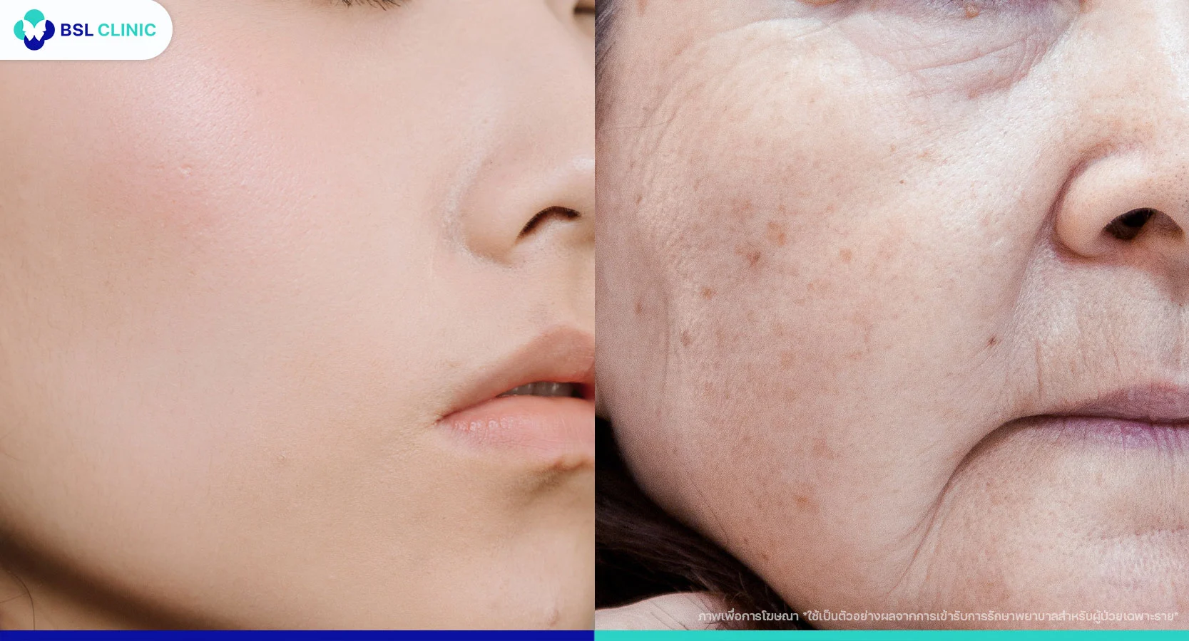 ผิวแห้งในผู้สูงวัย