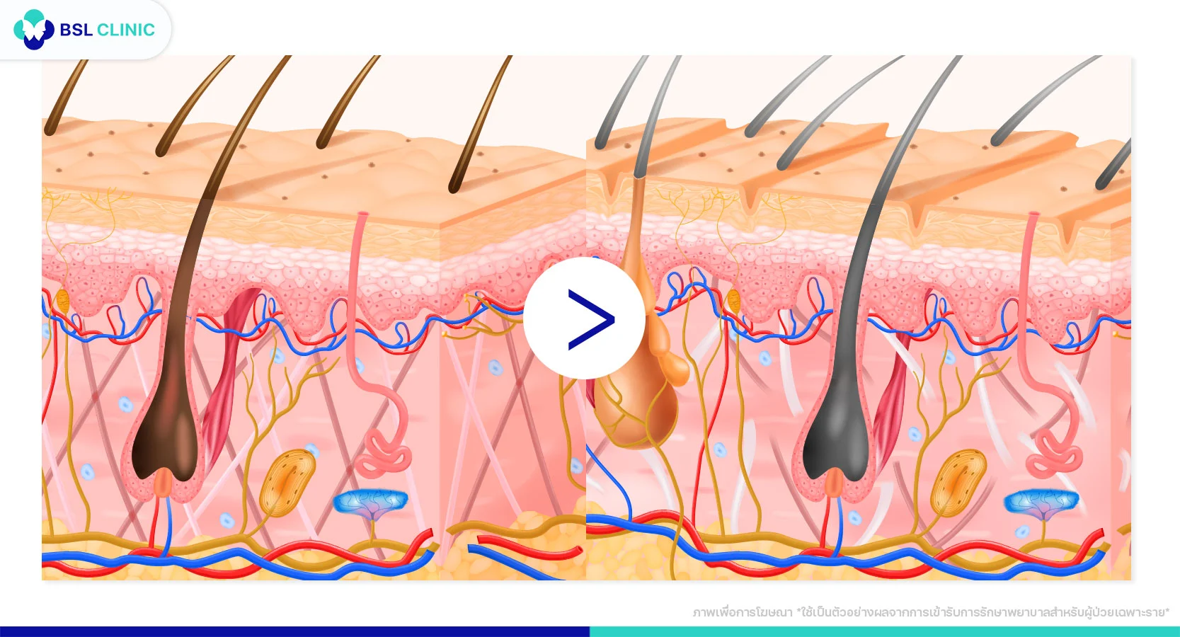 ผิวเหี่ยวย่น