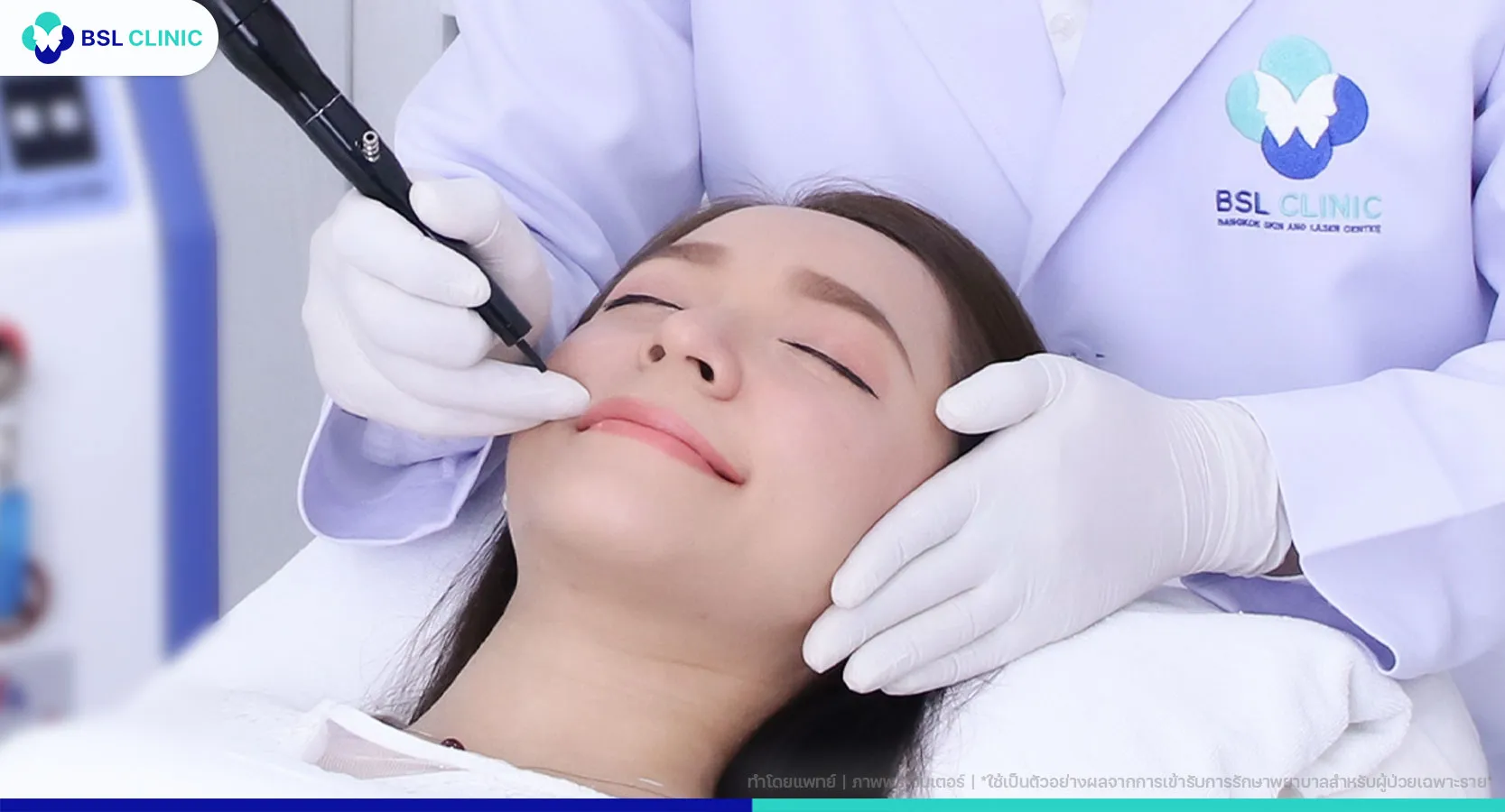 5 วิธี เลือกคลินิกเลเซอร์ไฝที่ไหนดี
