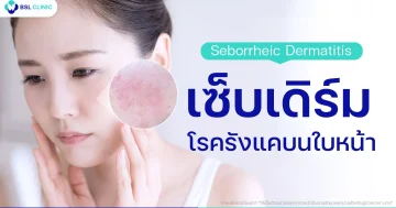 รังแคบนใบหน้า