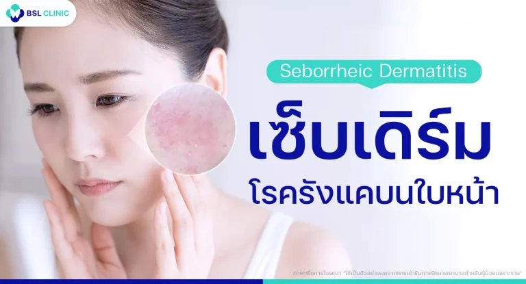 รังแคบนใบหน้า