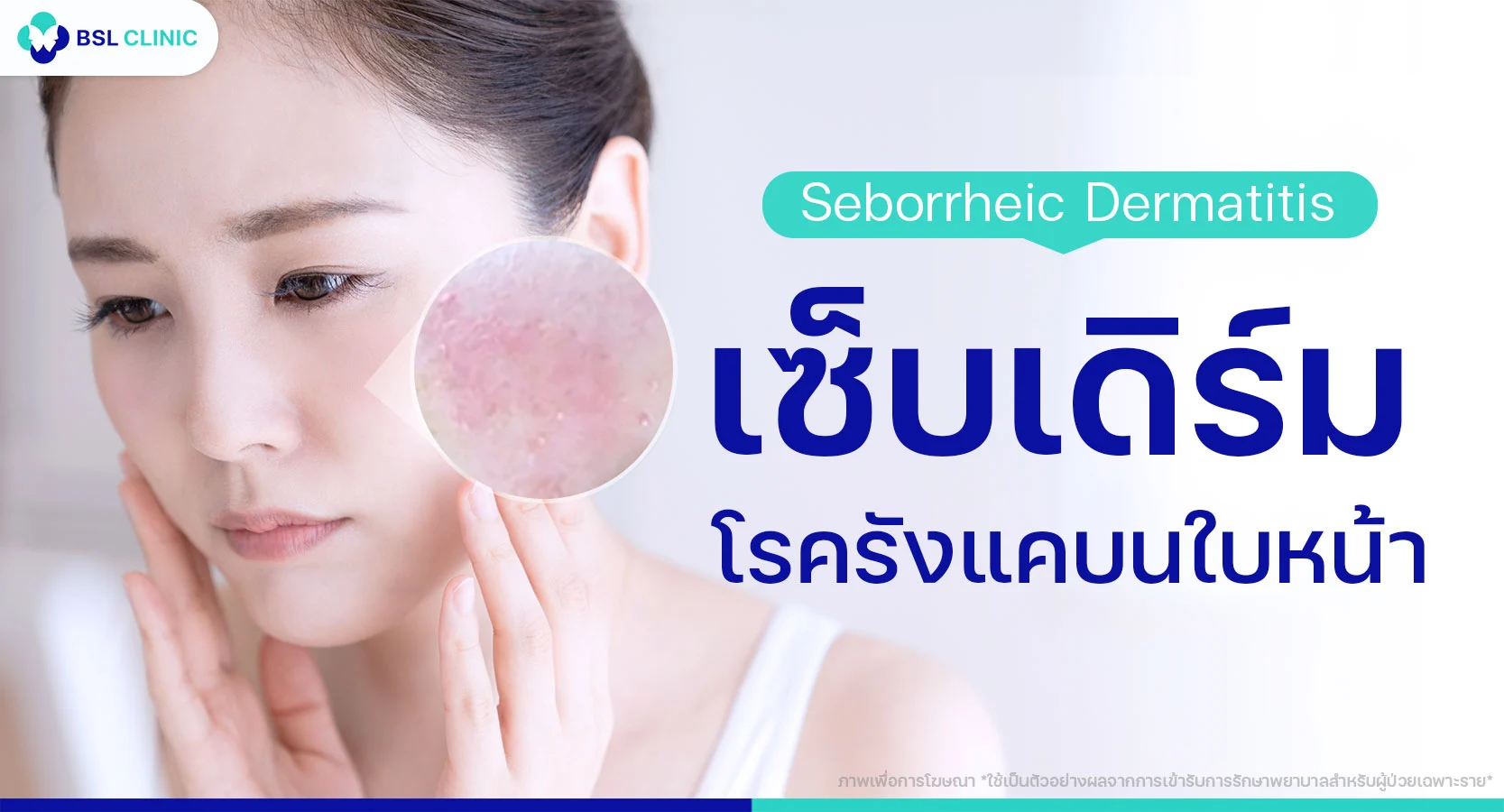 รังแคบนใบหน้า