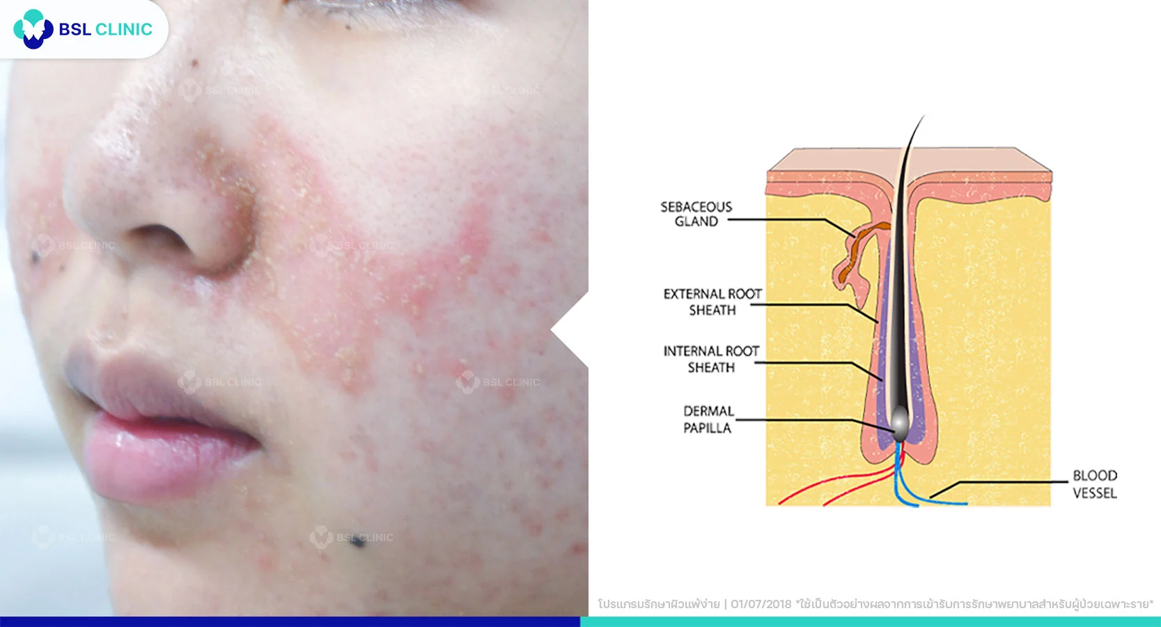 โรครังแคบนใบหน้า หรือ “เซ็บเดิร์ม”