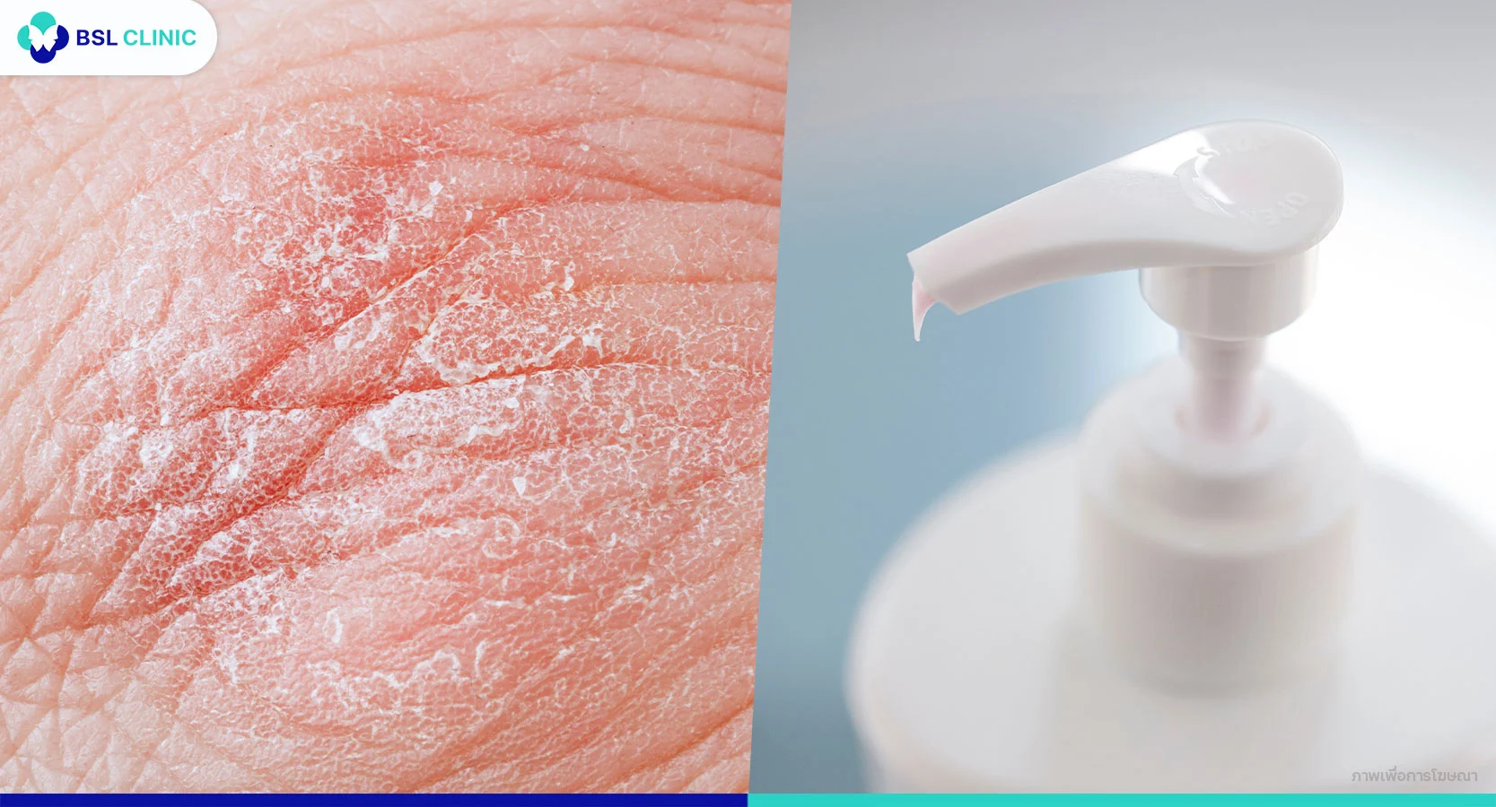 มอยเจอร์ไรเซอร์หน้าหนาว