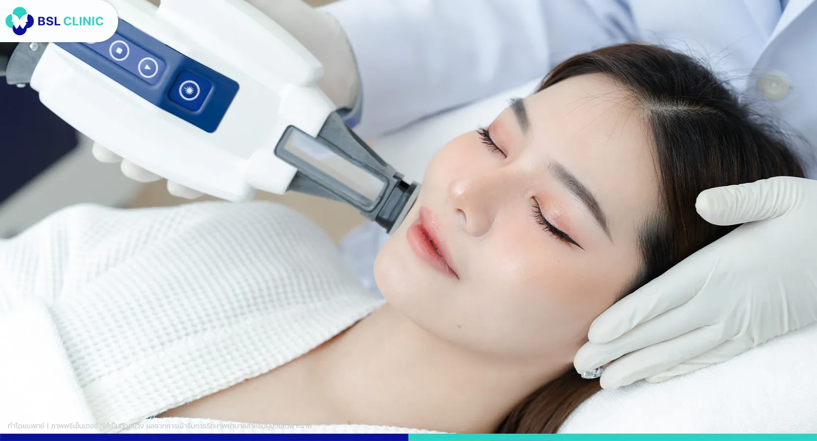 เลเซอร์สิว เพื่อผิวแข็งแรงขึ้น