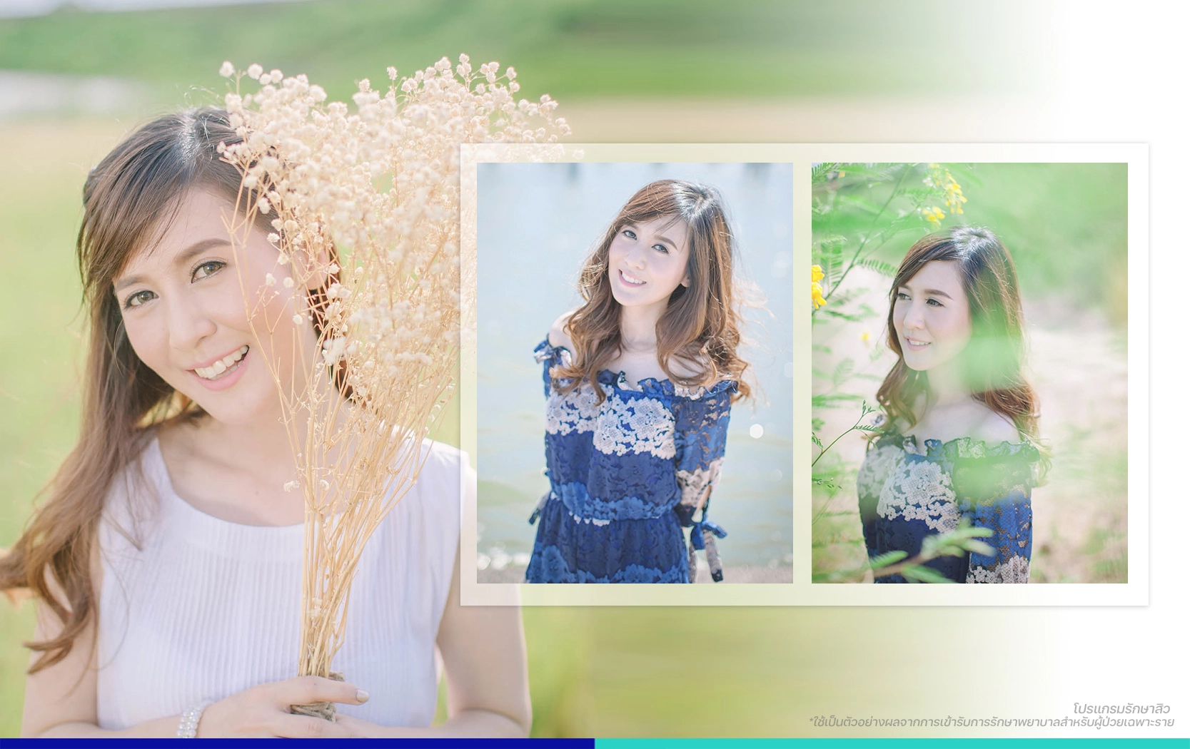 รีวิวรักษาสิว