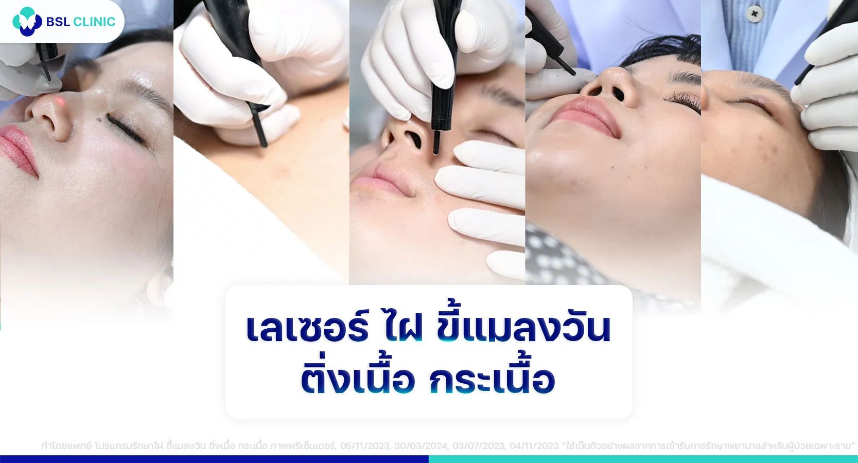 CO2 เลเซอร์ จี้ไฝ จี้กระ