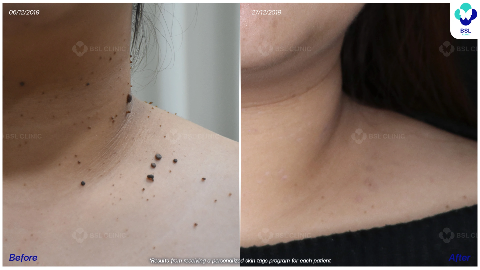 ผลการรักษา ไฝ ขี้แมลงวัน กระเนื้อ